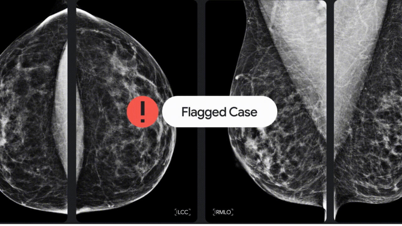 Google、乳がん検出技術向上に向けiCADと提携