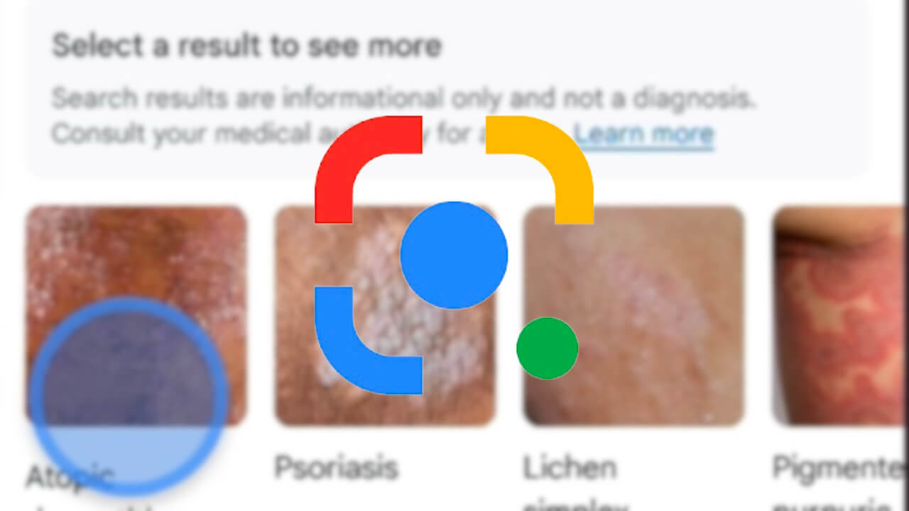 「Google レンズ」皮膚状態検索対応